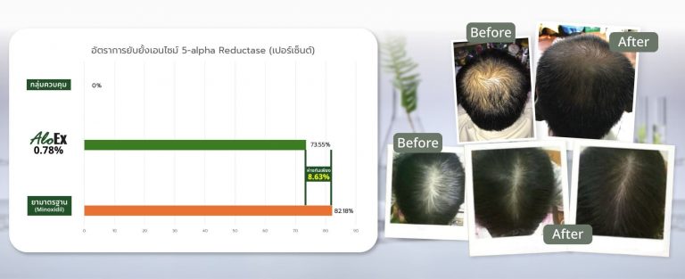 AloEx เทียบตัวยา Finasteride