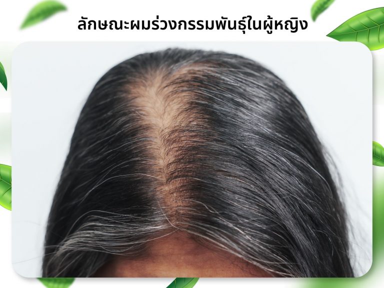 ผมร่วงกรรมพันธุ์ในผู้หญิง