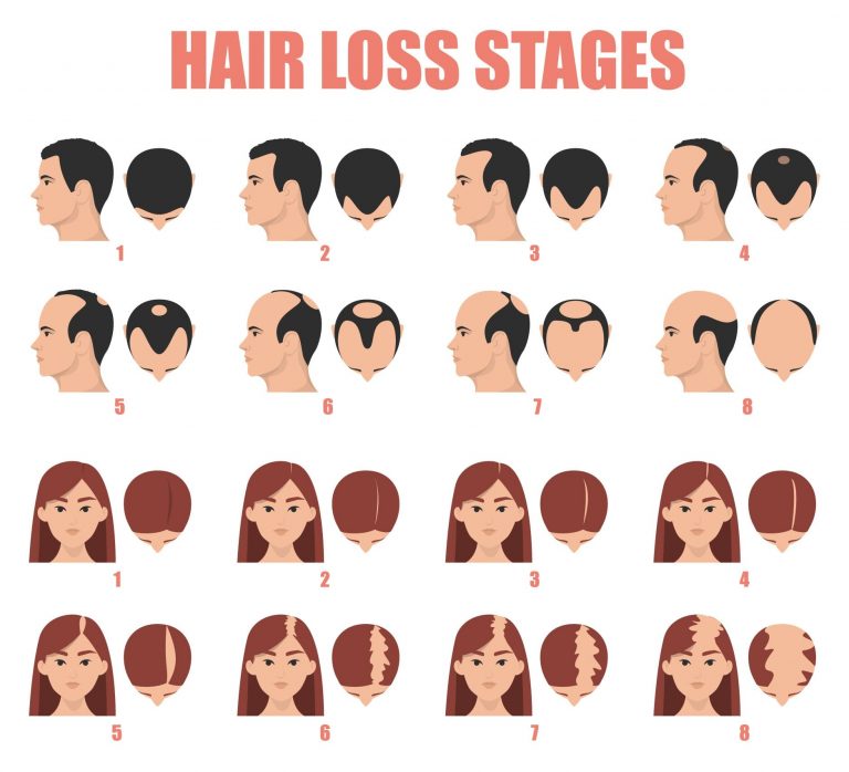 ลักษณะผมร่วงกรรมพันธุ์