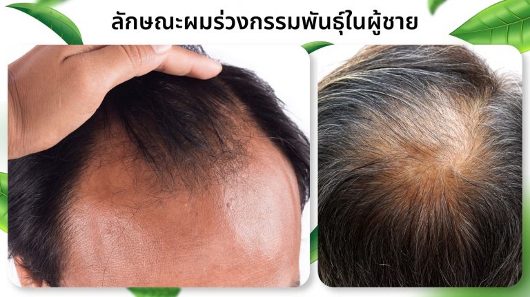 หัวล้านกรรมพันธุ์ในผู้ชาย