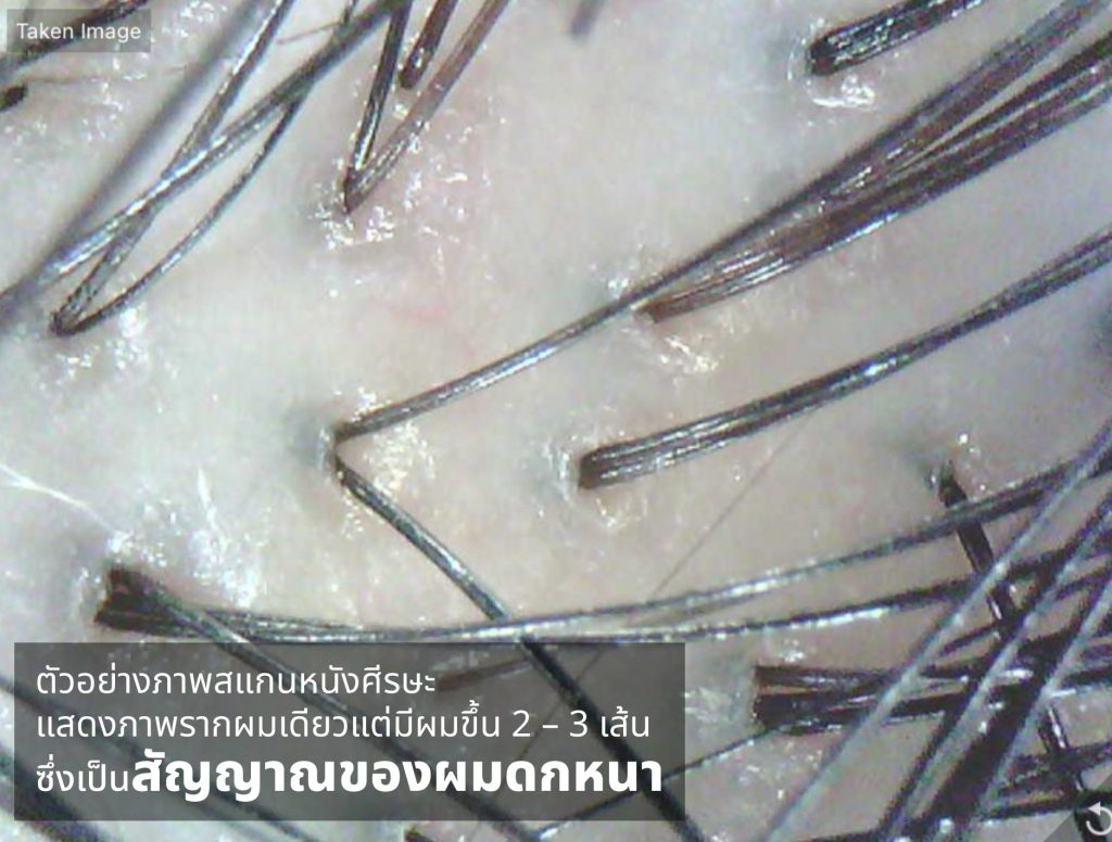 ภาพสแกน 1 รากผม มีผมงอกหลายเน
